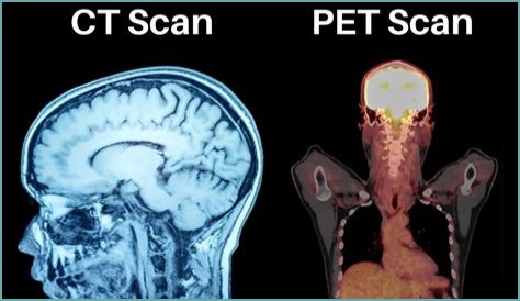 Can a PET scan detect squamous cell carcinoma?